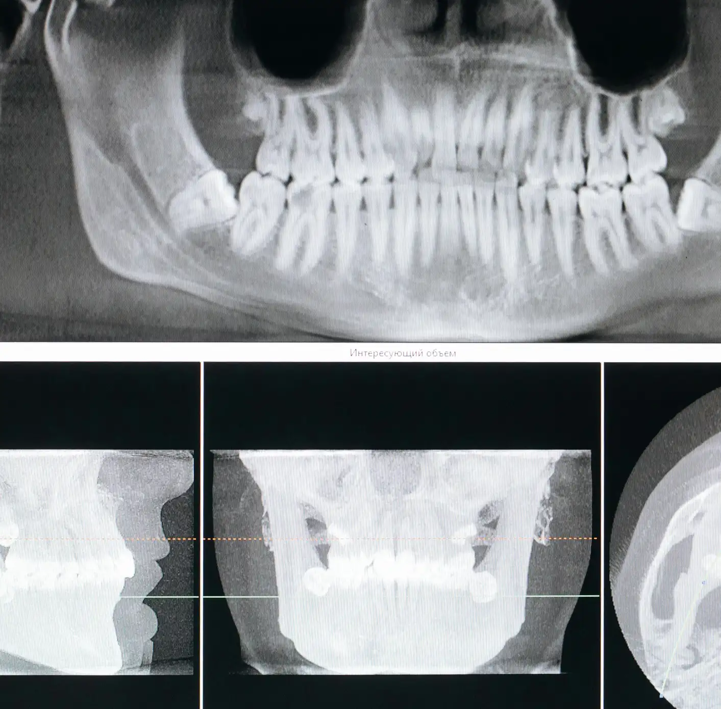 Dental X-ray images showing panoramic and sectional views of teeth and jawbone, including dental implants.