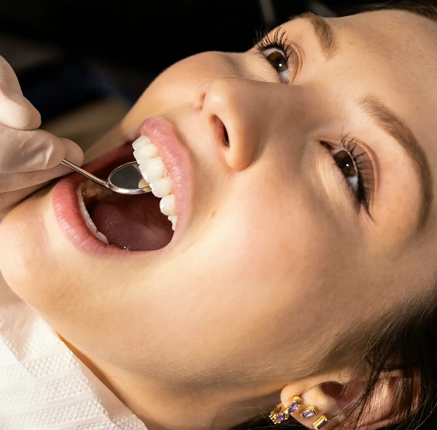 Close-up of a person receiving a dental implants with a dentist’s gloved hand holding a mouth mirror inside their open mouth.
