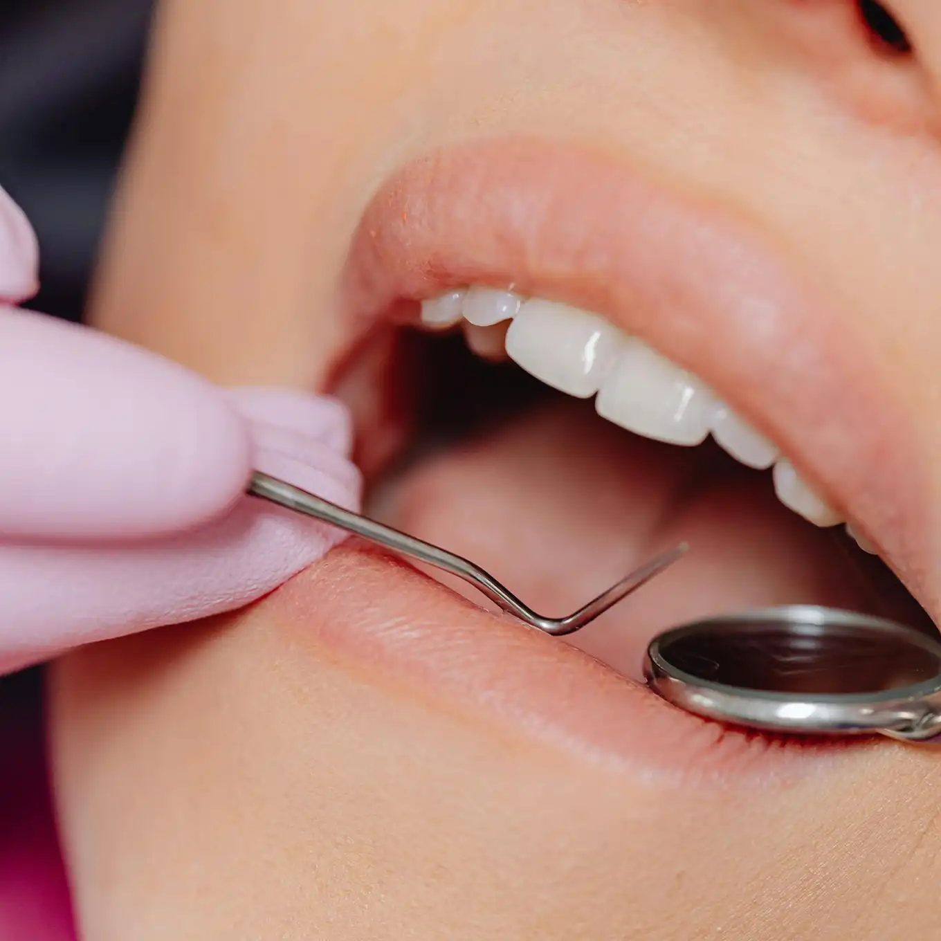 Close-up of a dental exam showing a mouth open with clean white teeth and a dental mirror and probe inside.