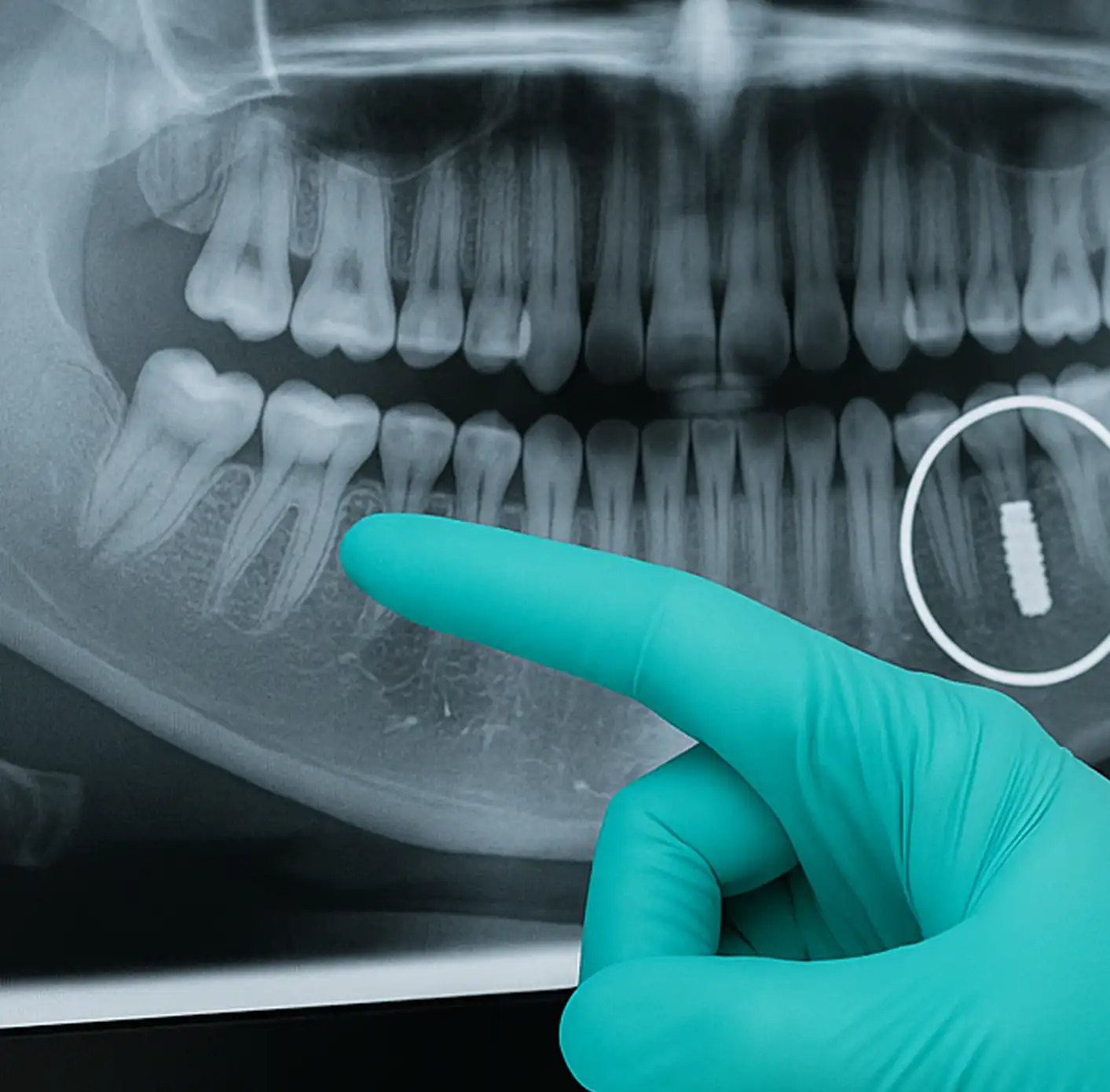 Dental X-ray showing teeth and jawbone with a dental implant highlighted in a white circle and a gloved hand pointing at it.