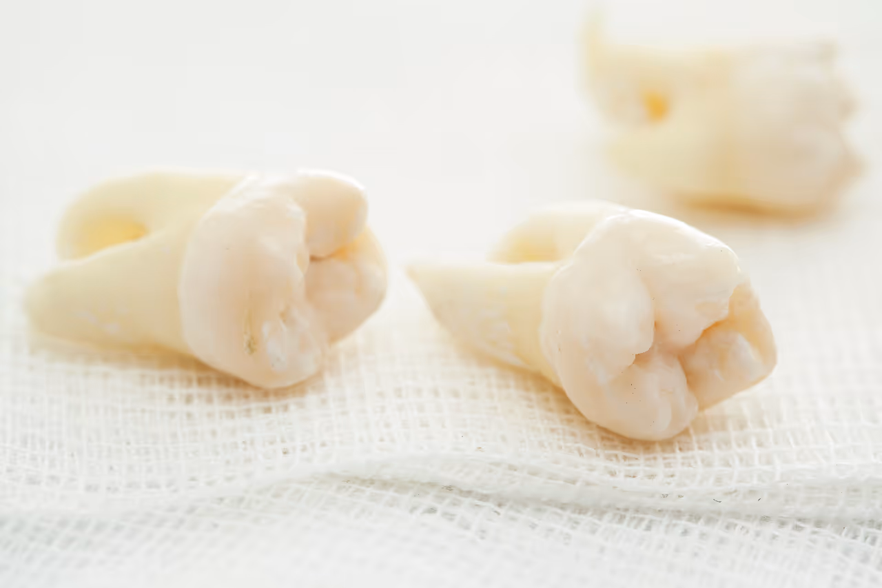 Wisdom Teeth Removal in La Verne, CA