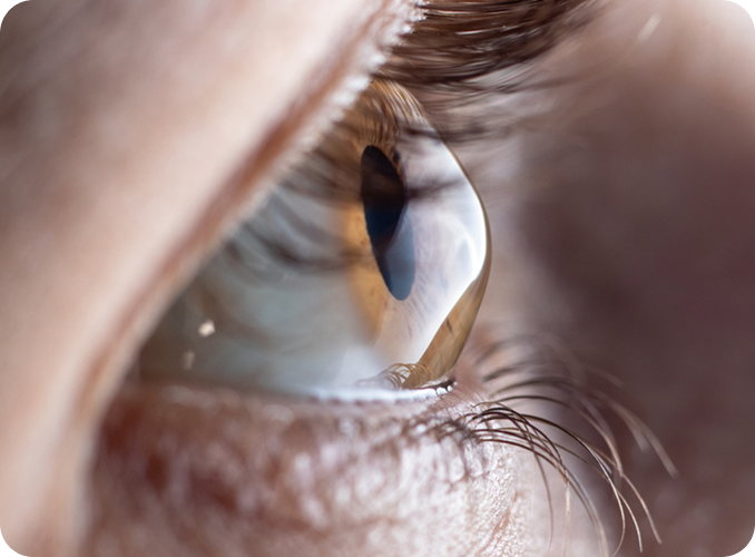 keratoconus lenses