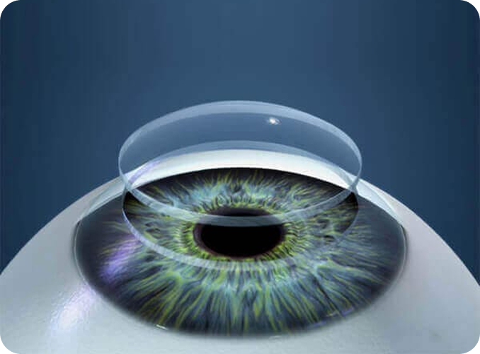 corneal transplant