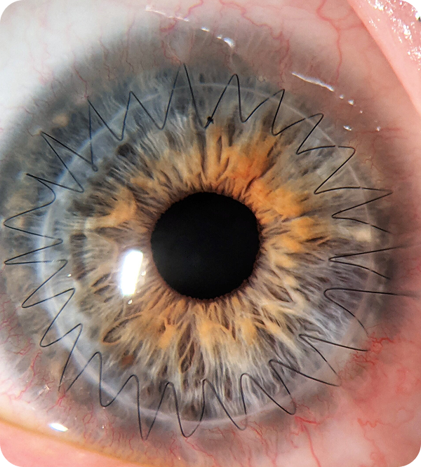 Penetrating+Keratoplasty