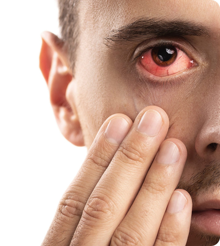 Chemical Eye Burn Causes Symptoms and Treatment Options scaled