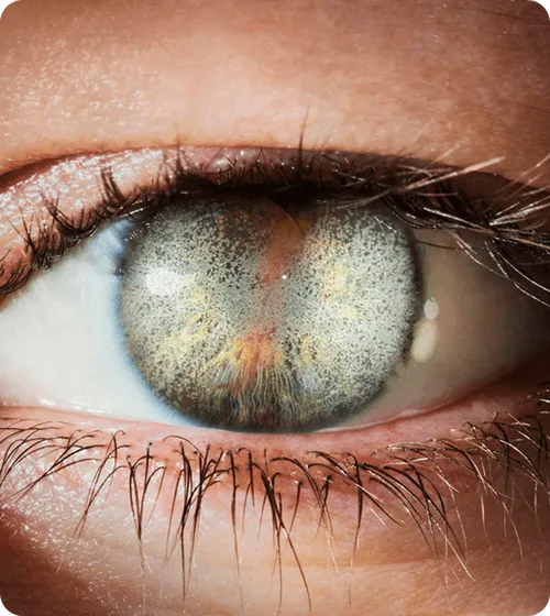 corneal dystrophy