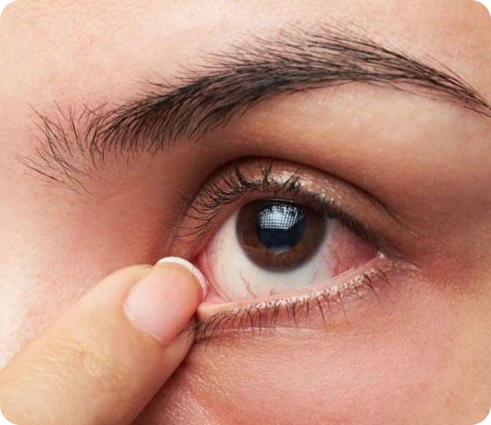 corneal degenerations treated