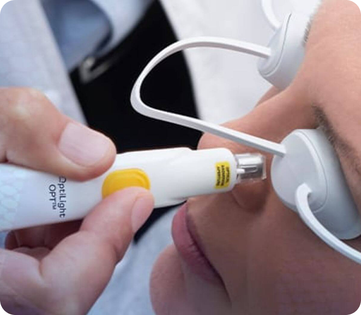 Is IPL for Dry Eyes Covered by Insurance