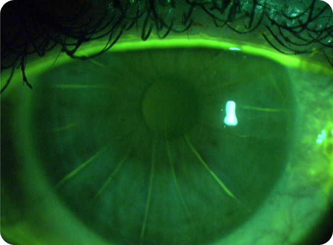 What Happens To The Flap Created During Lasik Surgery
