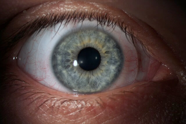 What Is It Like to Wear Scleral Lenses with Advanced Keratoconus?