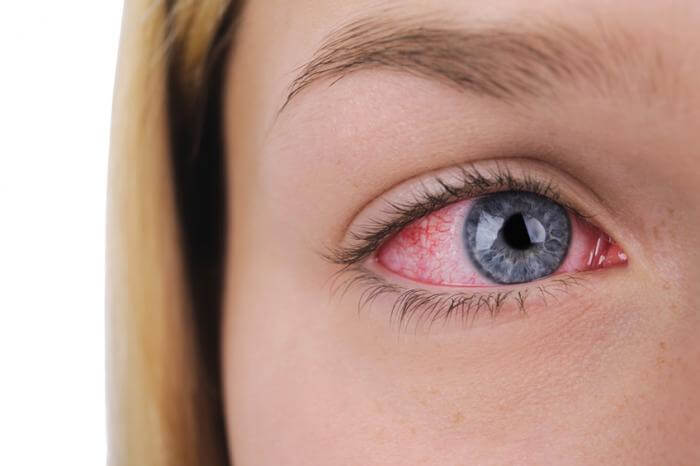 6 Ways Seasonal Allergies Affect Your Eyes