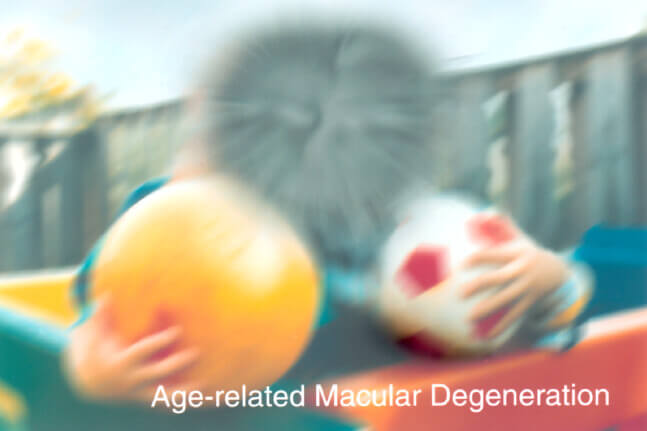 Macular Degeneration Causes, Treatment, and Prevention