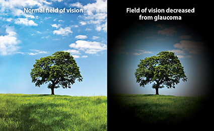 What is Glaucoma?