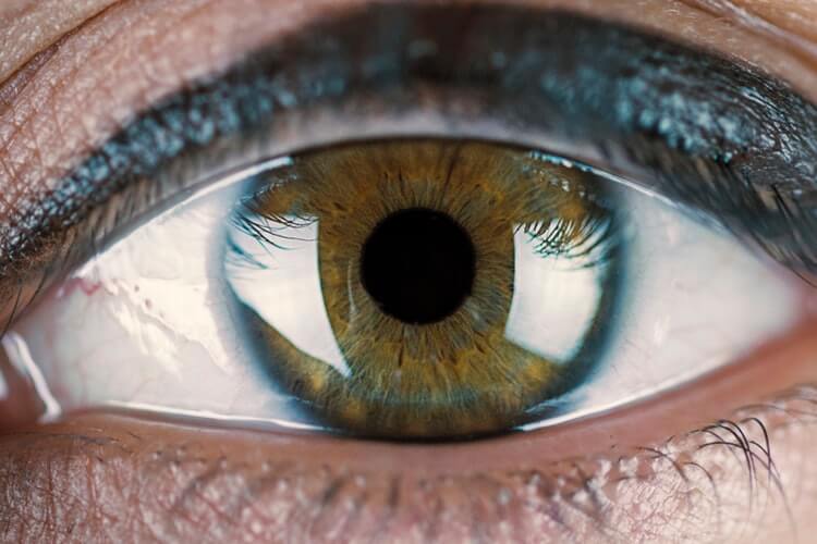 Irregular Corneal Astigmatism and Scleral Lenses