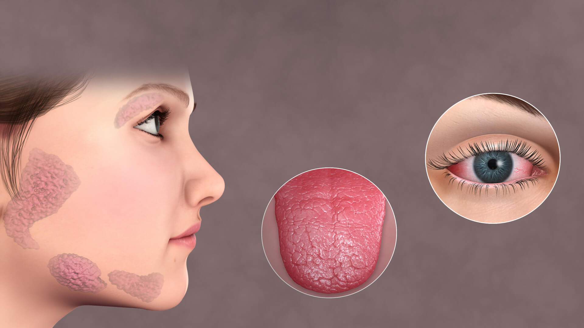 Sjogren’s Syndrome Patients Who Suffer from Dry Eye Explained