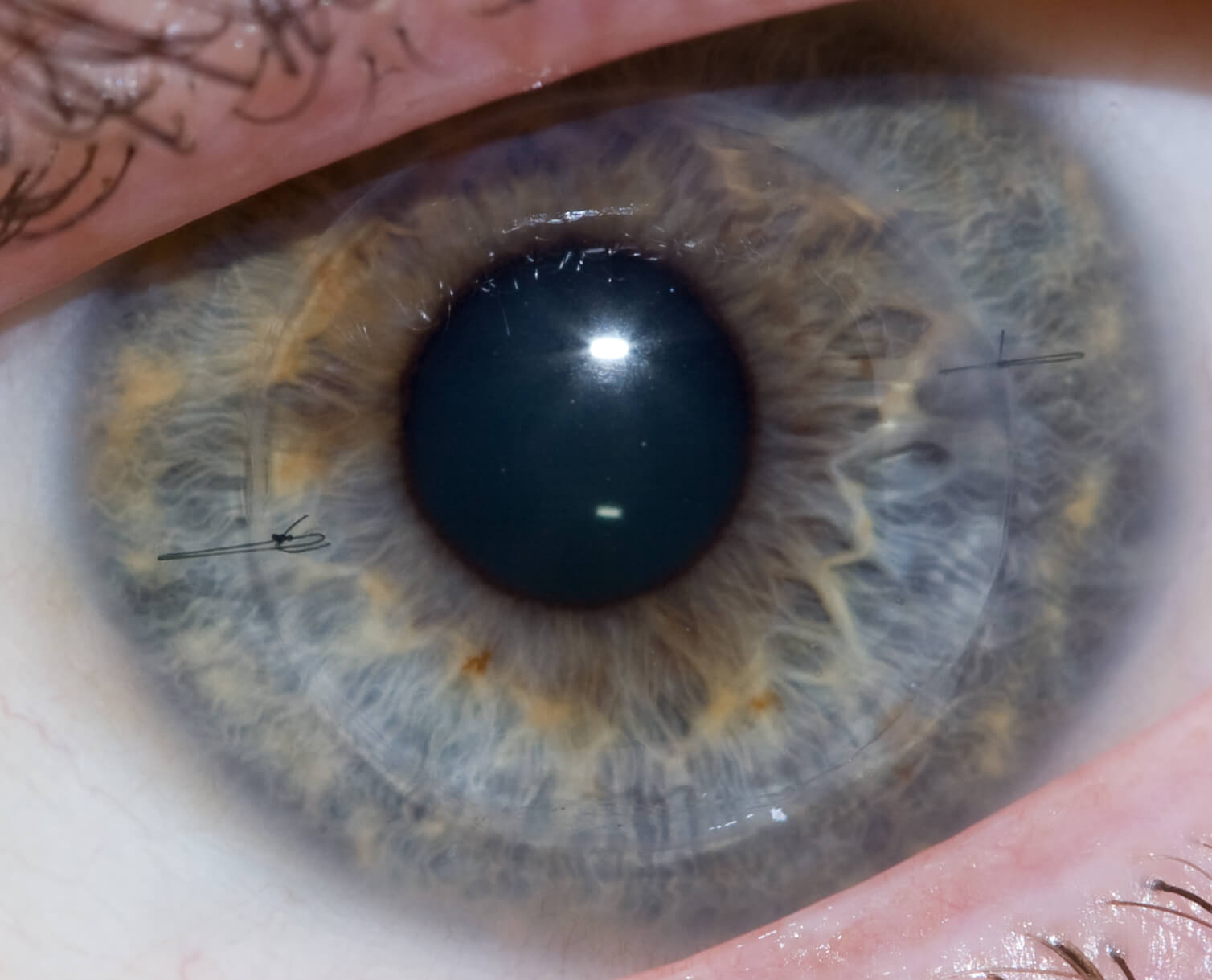 Can Scleral Lenses Reduce the Need for Corneal Transplants?