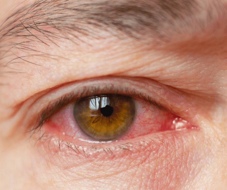 red eye