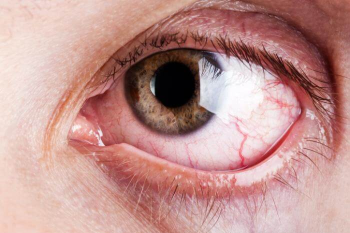 Do I Need Contacts If I Have Dry Eye?