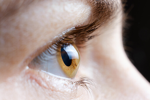 What is it Like to Have Keratoconus?