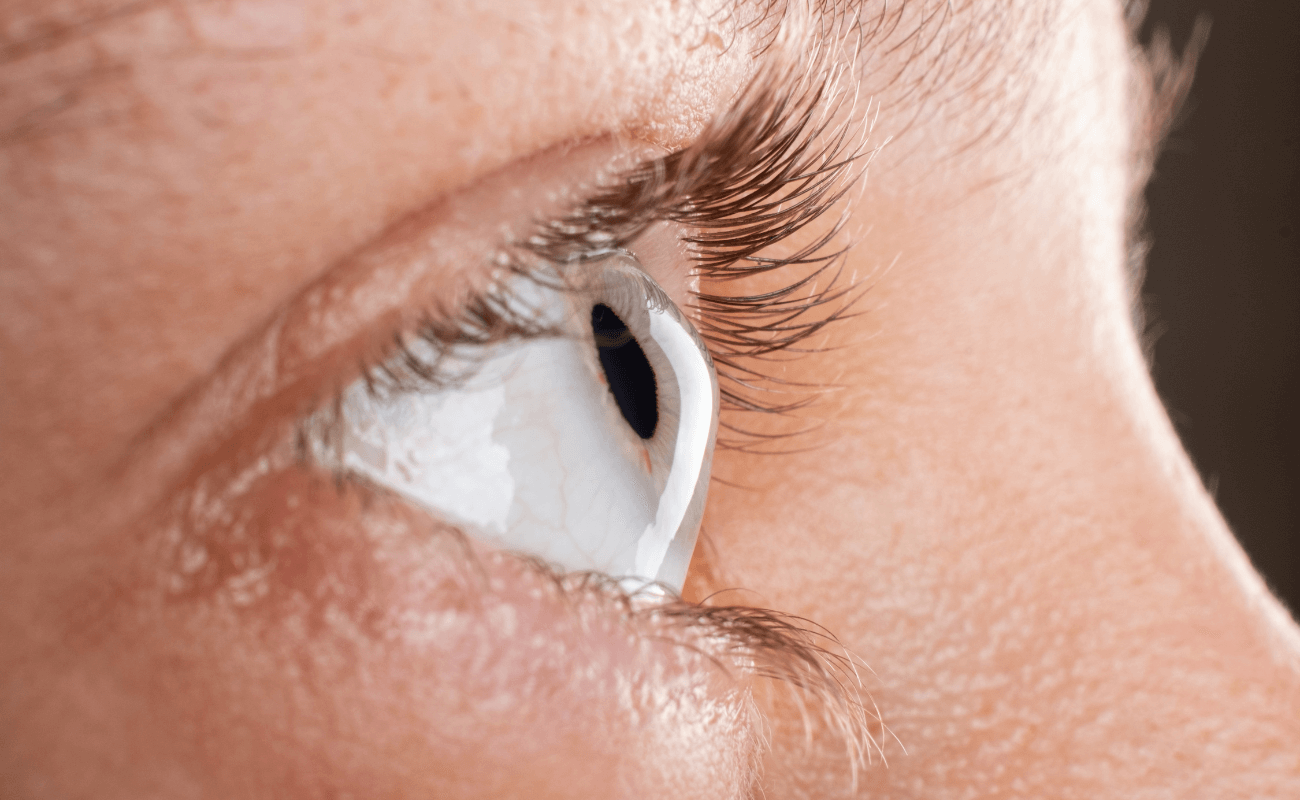 Scleral Lenses and Their Use in Managing Corneal Ectasia