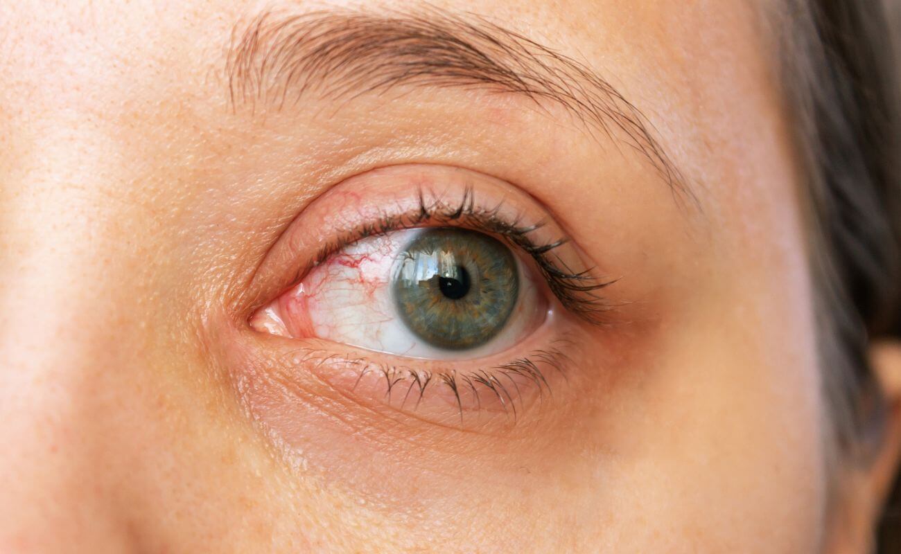 The Benefits of Radio Frequency for Dry Eyes: A Comprehensive Guide