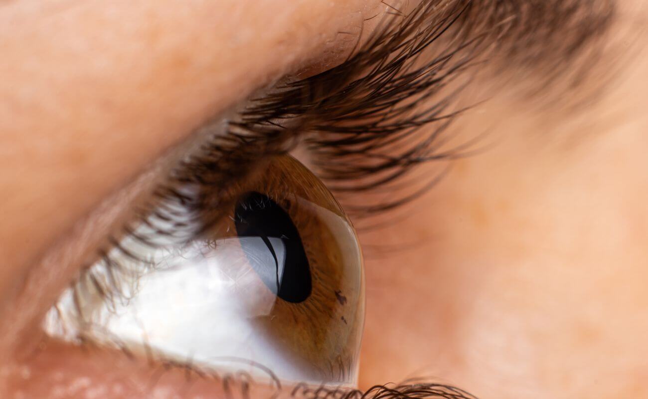 Can Scleral Lenses Correct Keratoconus- Affected Vision?