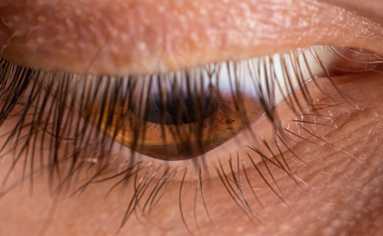 What are the Common Signs That Your Keratoconus Prescription Needs Updating