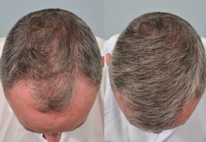 Hair transplant treatment at a partner clinic in Chișinău