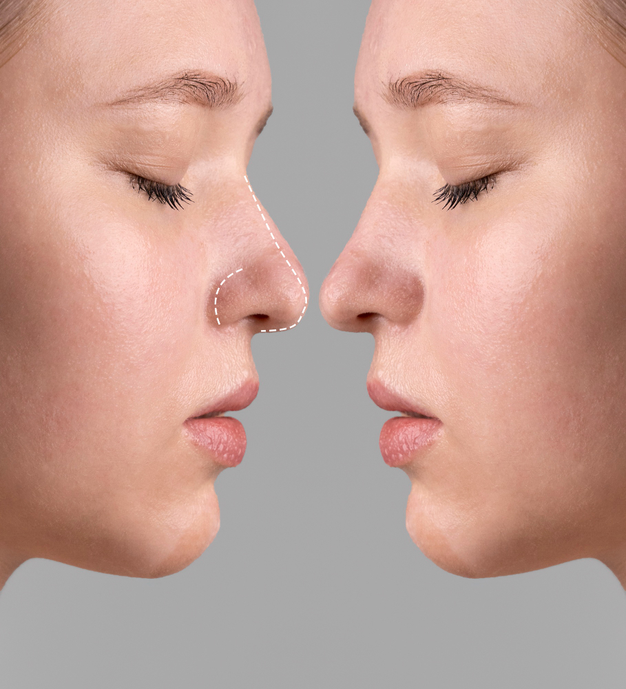 Rhinoplasty (nose surgery) at a partner clinic in Chișinău