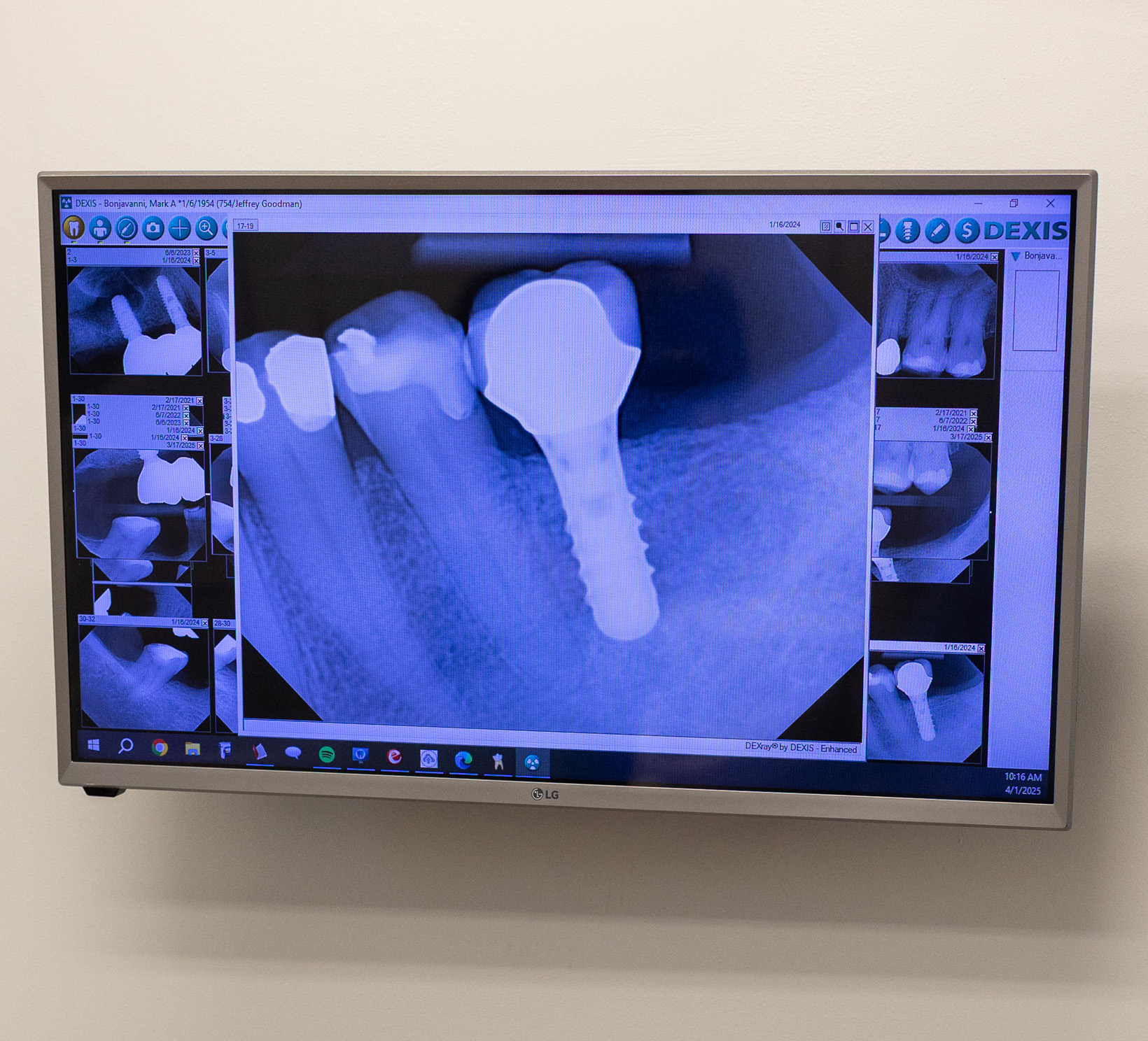 Implant scan