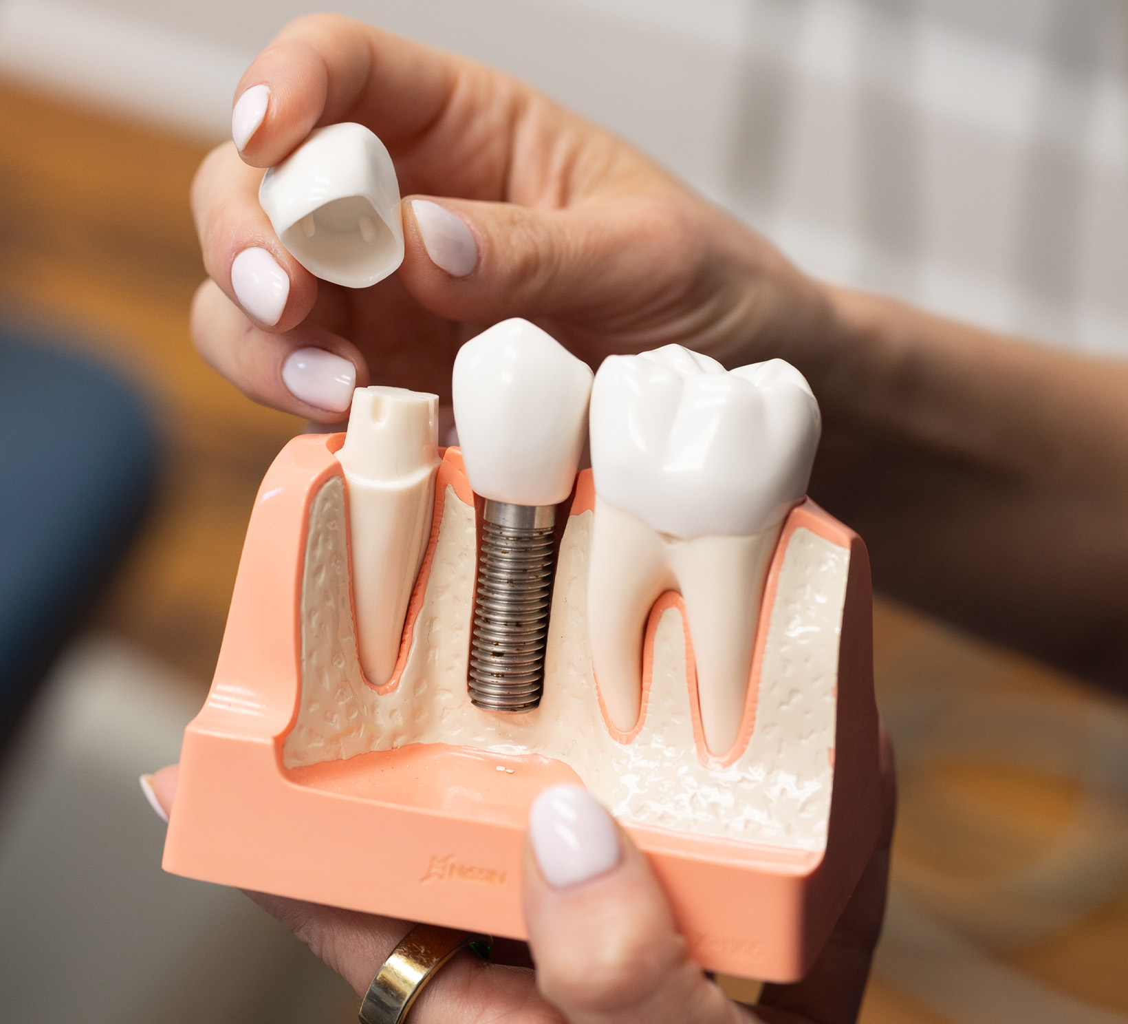 Model of a Dental Crown