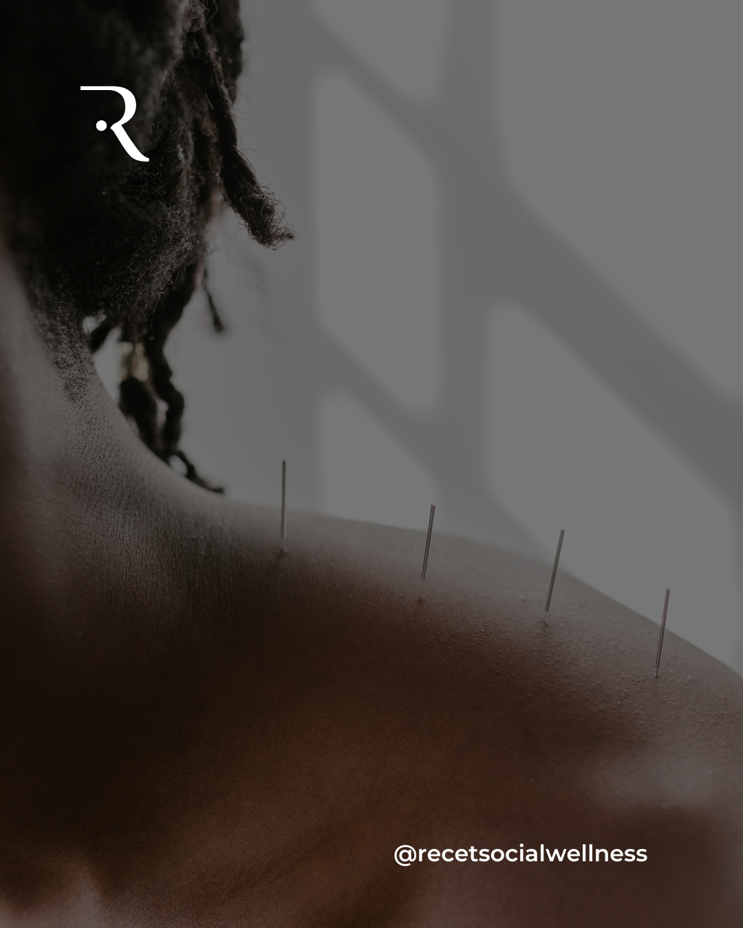 Benefits of Acupuncture
