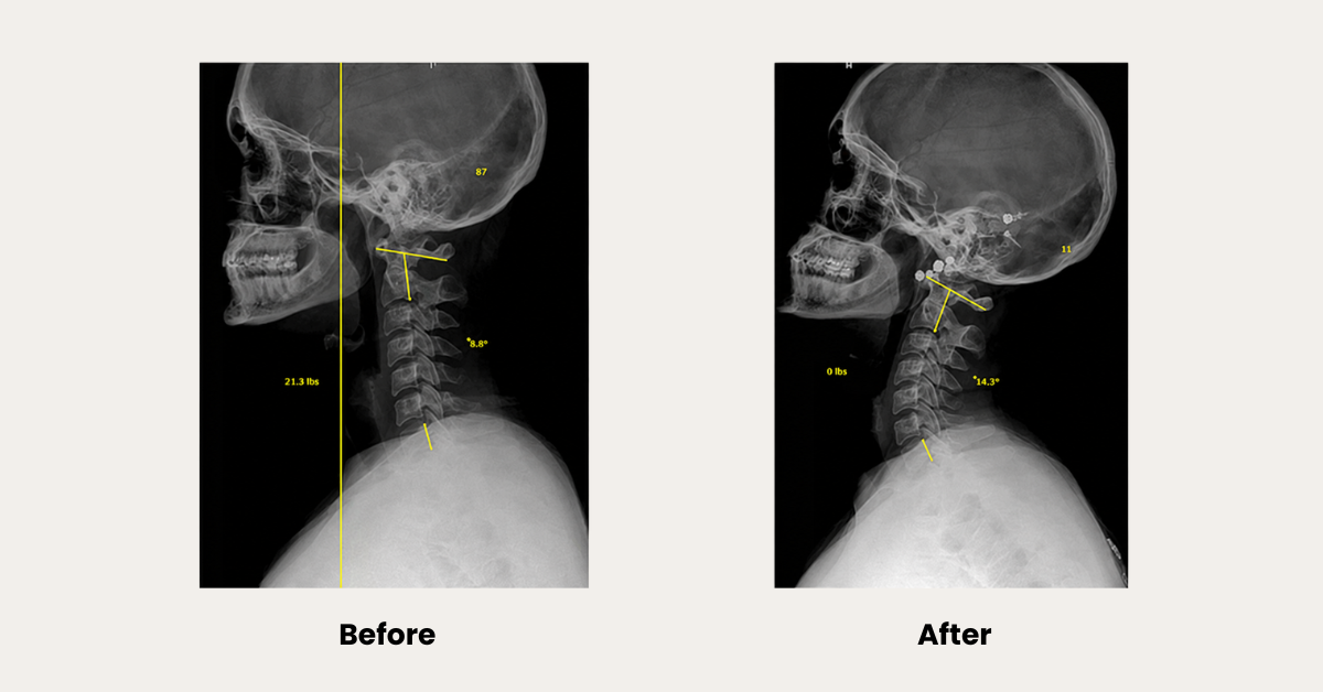 Before-and-after cervical spine X-rays showing changes in neck alignment following corrective chiropractic care.