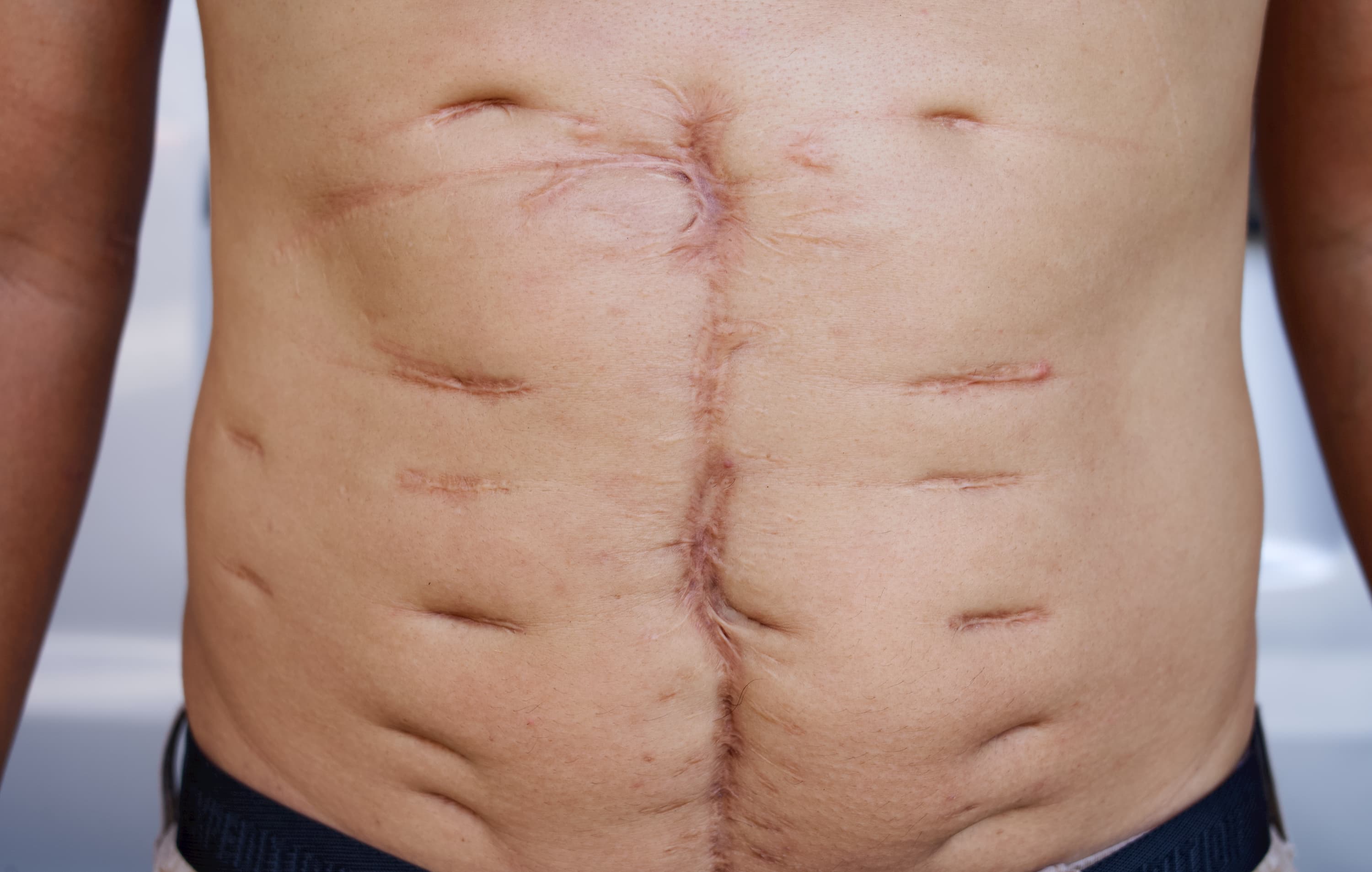 A man with a scar on his stomach.