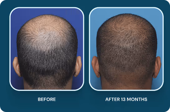 Hair Regeneration Before and After 10 Months