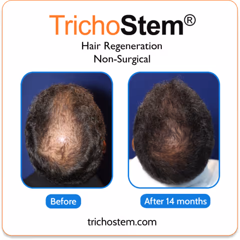TrichoStem Hair Regeneration 