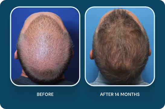 TrichoStem Hair Regeneration Results