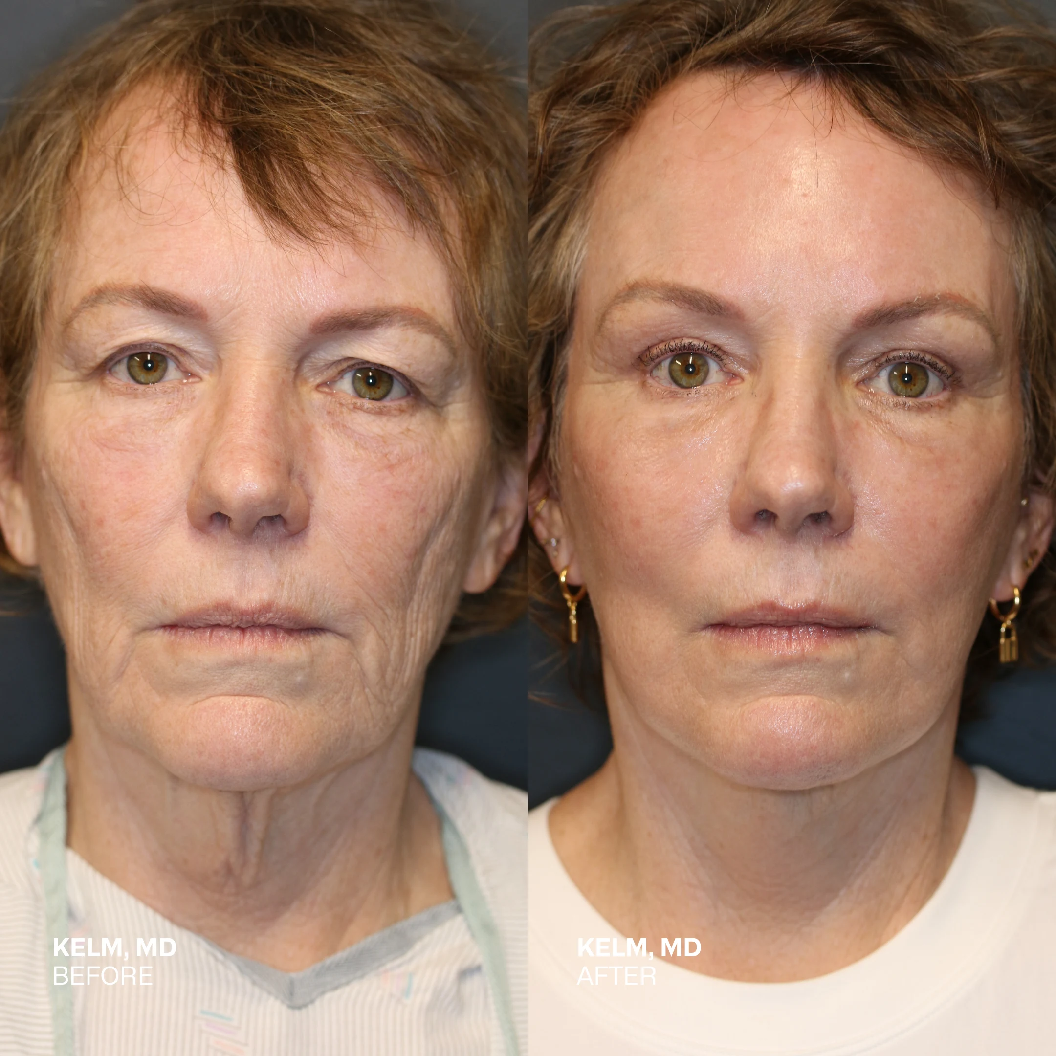 Before and After Image of Lisa - Kelm's Cosmetic Journey