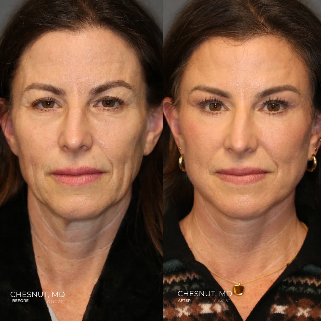 Before and After Image of Julie at 7 Months- Chesnut's Cosmetic Journey