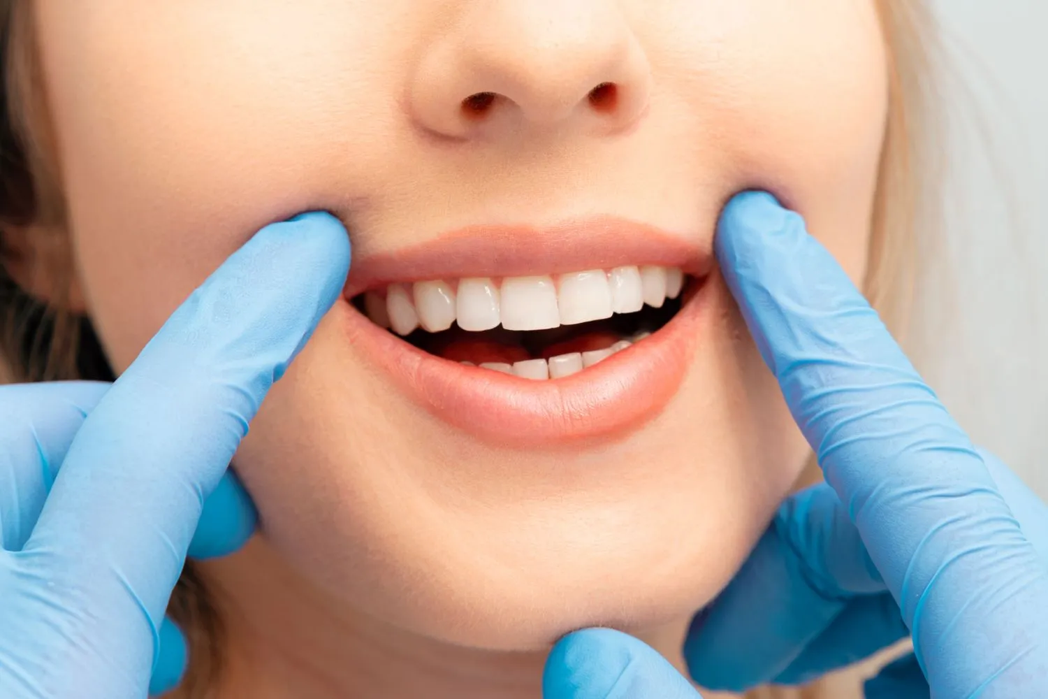 Close-up of a woman’s healthy white smile being gently examined by a dentist wearing blue gloves, emphasizing oral health and aesthetics.