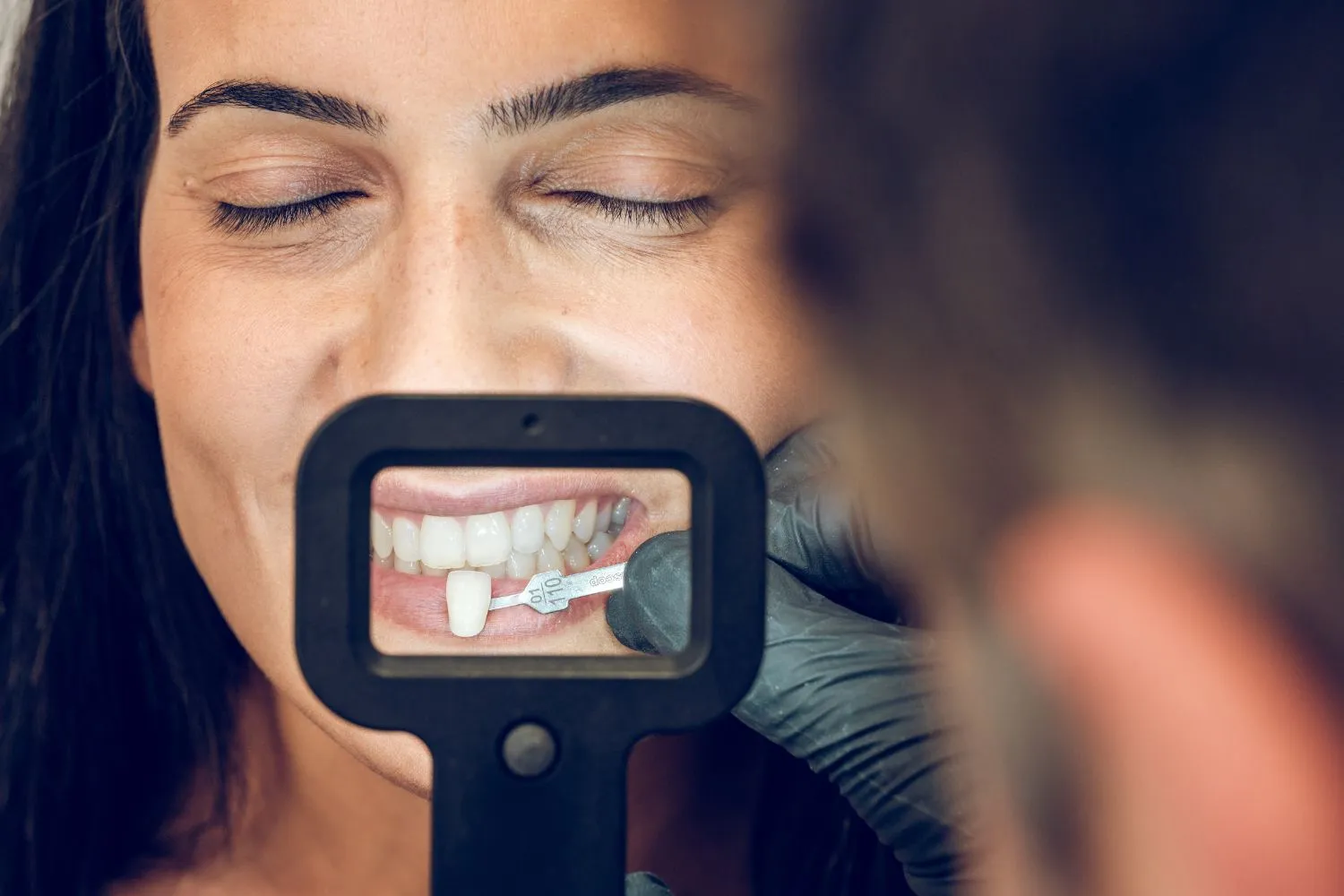 A close-up of a woman’s smile being photographed with a dental camera to document cosmetic dental results or treatment planning.