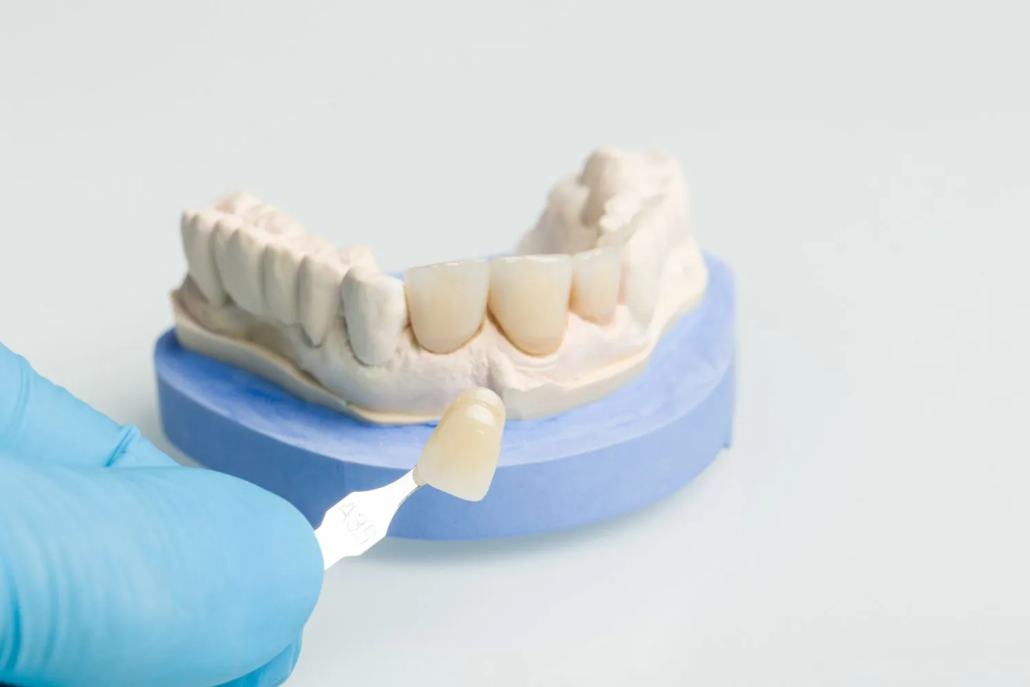 Close-up of a dental technician using a shade guide to match a crown to a dental model with prepared teeth.