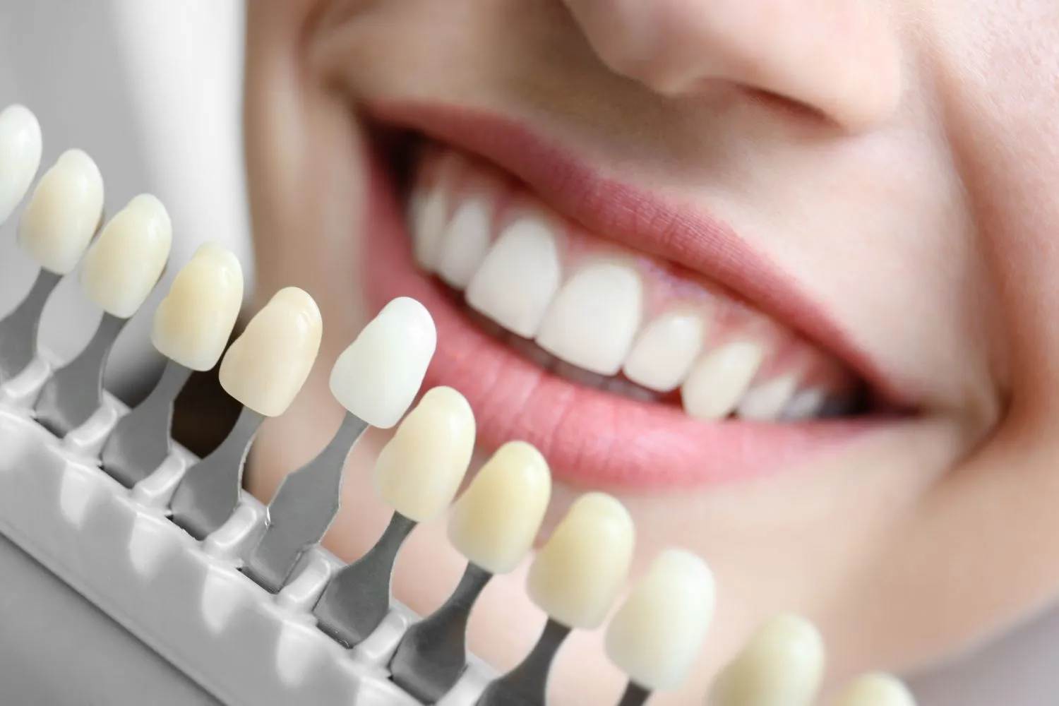 Close-up of a person smiling behind a tooth shade guide, comparing whitening results and matching the ideal tooth color.