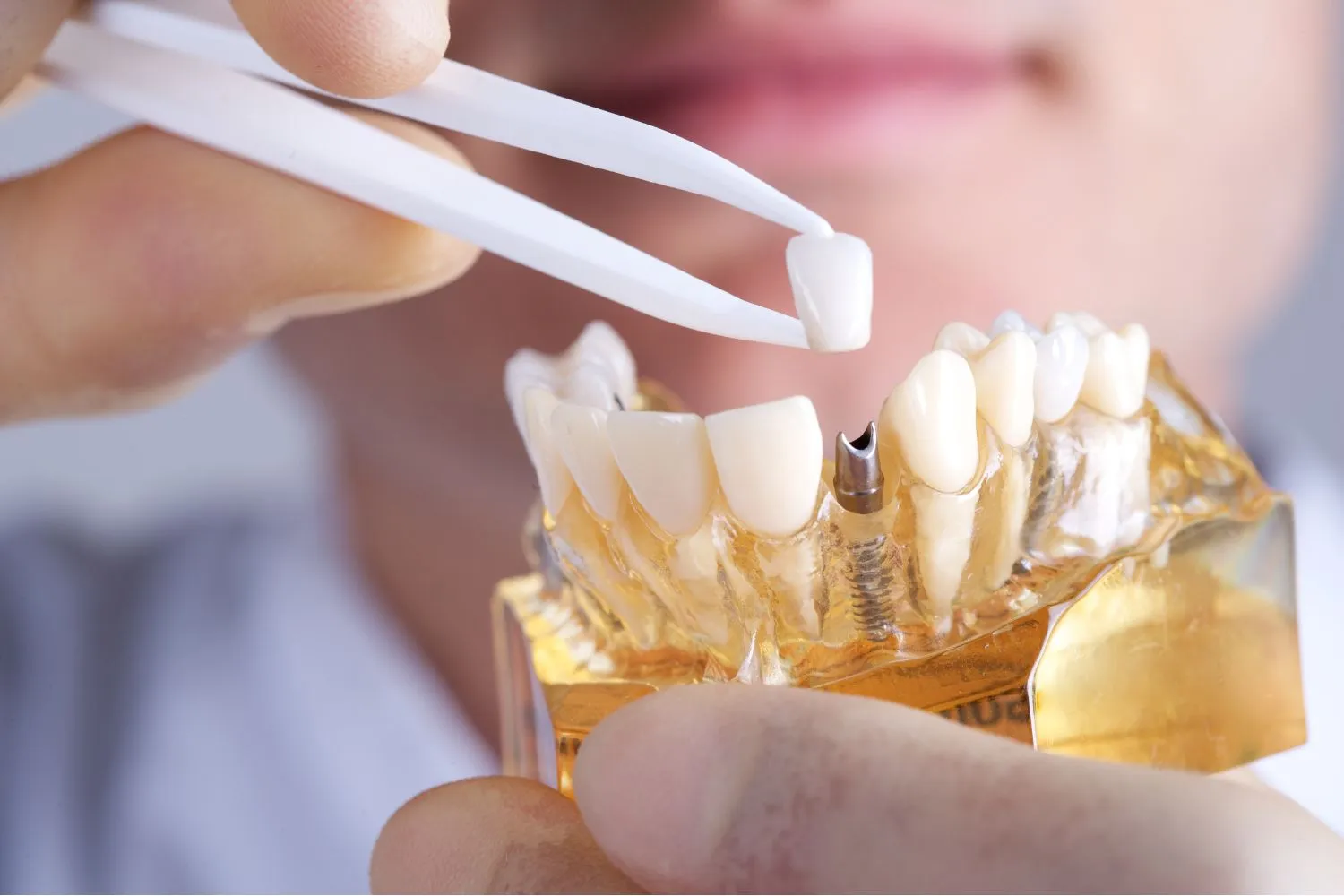 A close-up of a dentist using tweezers to position a dental crown on a tooth model during a restoration demonstration.
