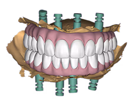 EviSmart CAD does Implant restoration
