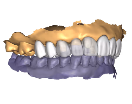 EviSmart CAD does crown and bridge