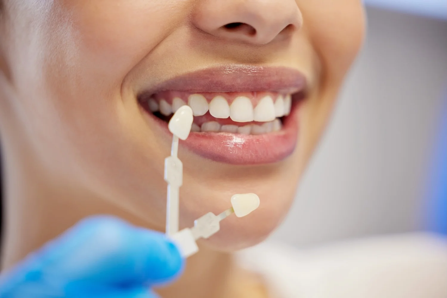 Dental Veneers of Caucasian Woman
