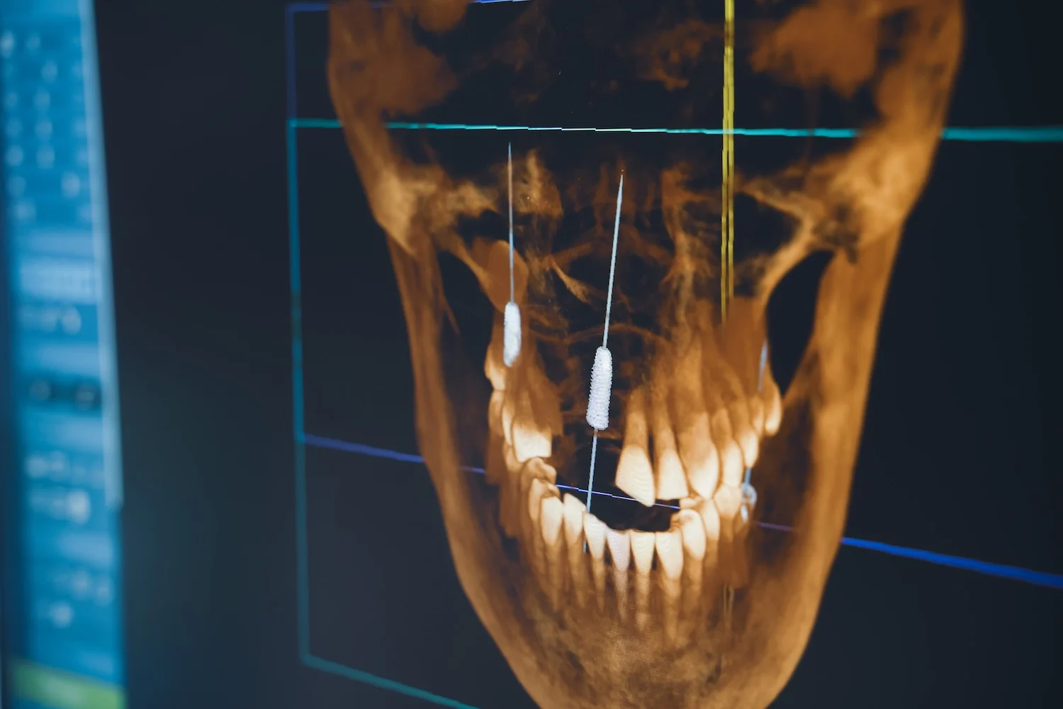 3D XRAY examination of teeth