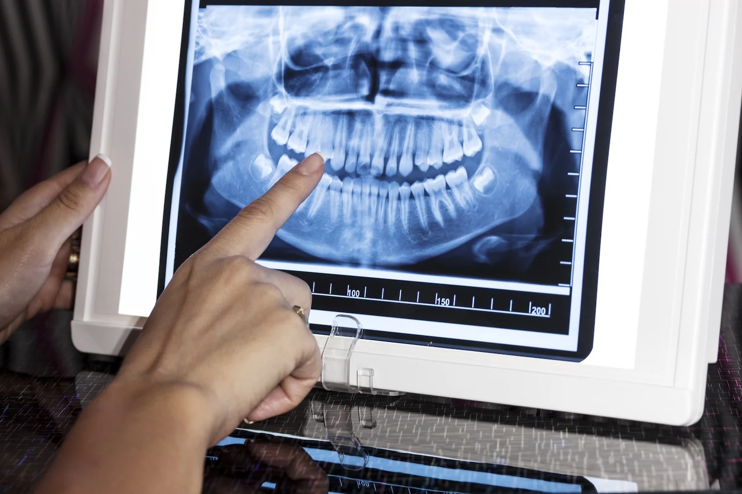 XRAY Examination of Teeth