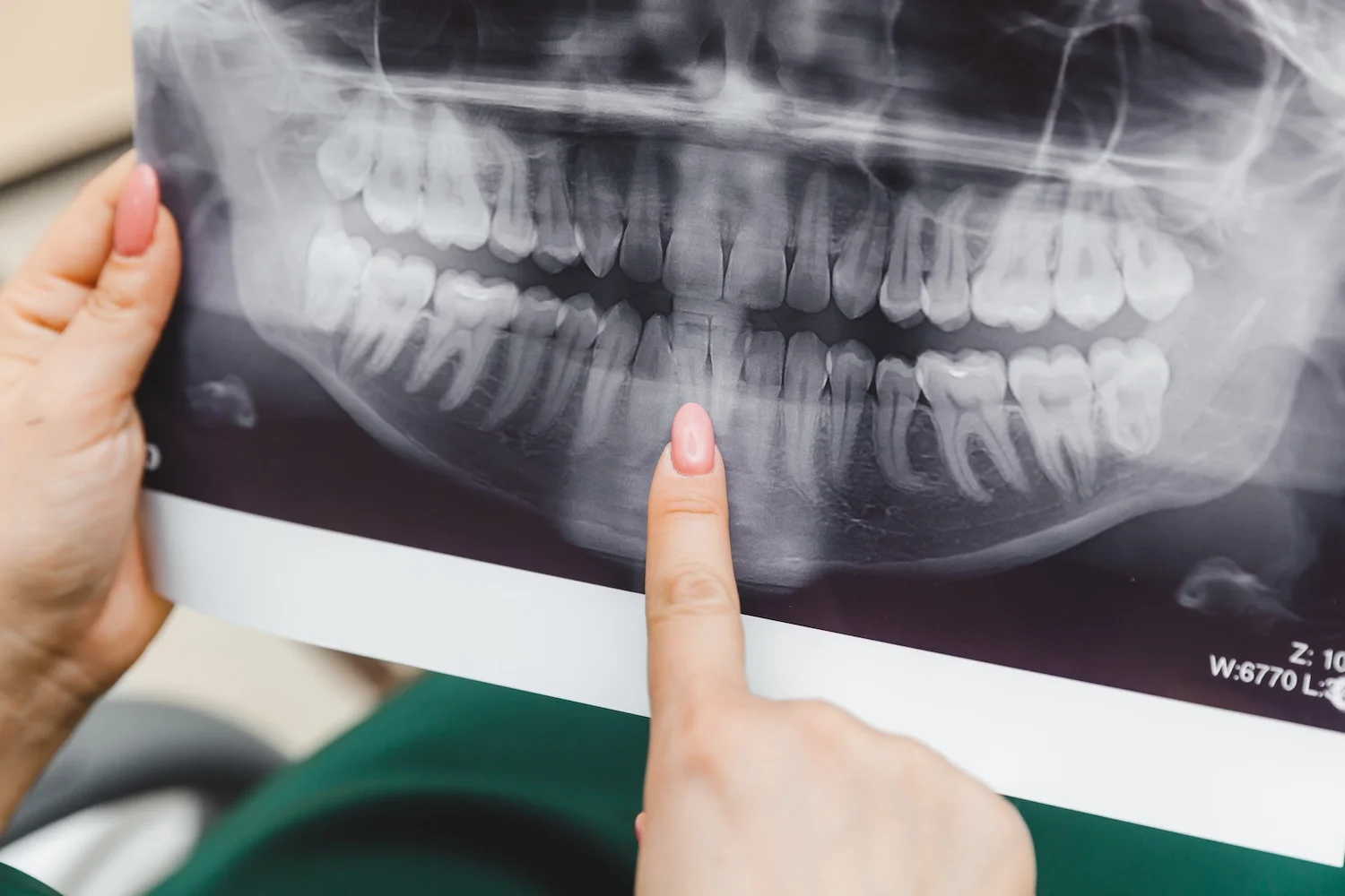 XRAY Examining of Teeth